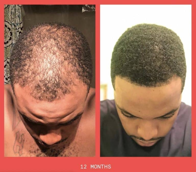 Keeps Hair Review Must Read This Before Buying