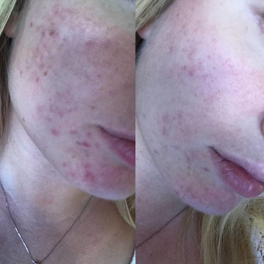 Sand and Sky Skincare Review