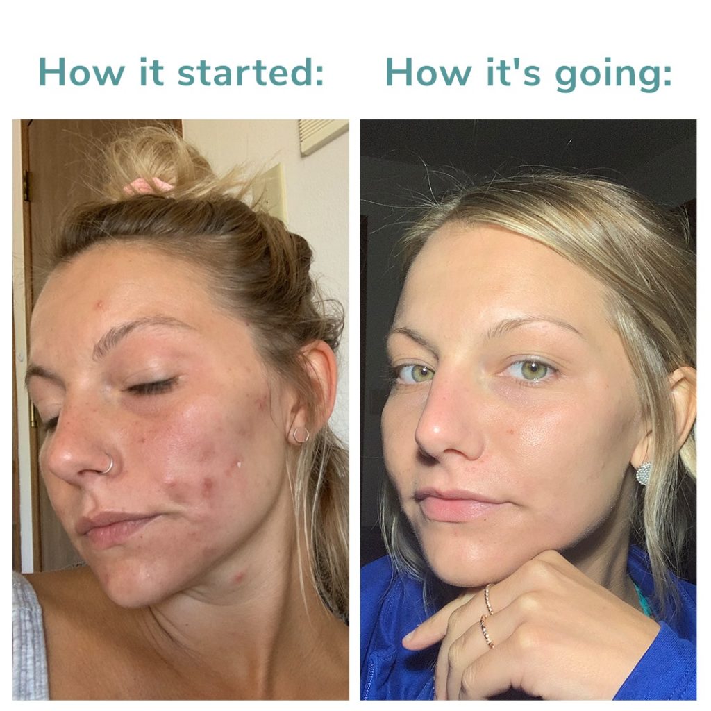 Rory Skincare Review Before and After