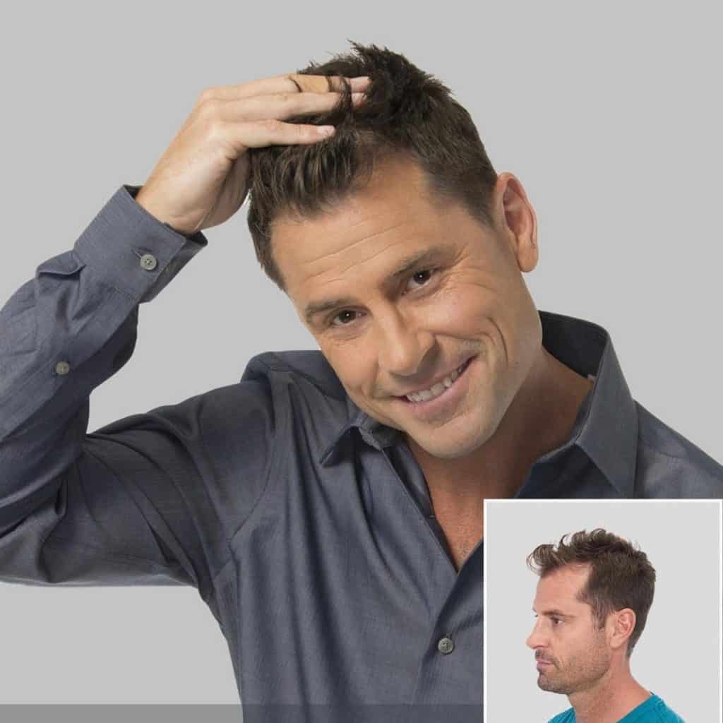 Hair Club FUE Hair Transplant Review