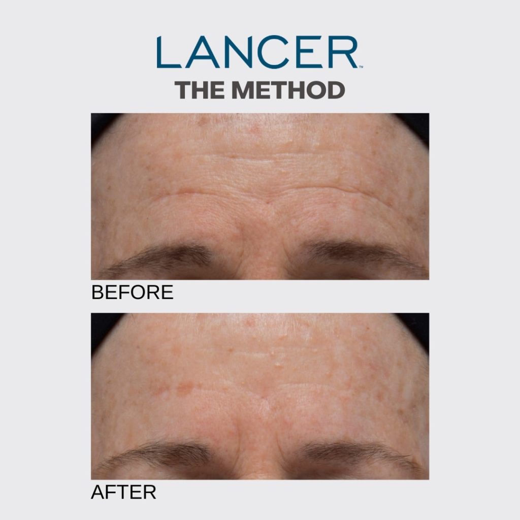 Lancer Skincare Review 
