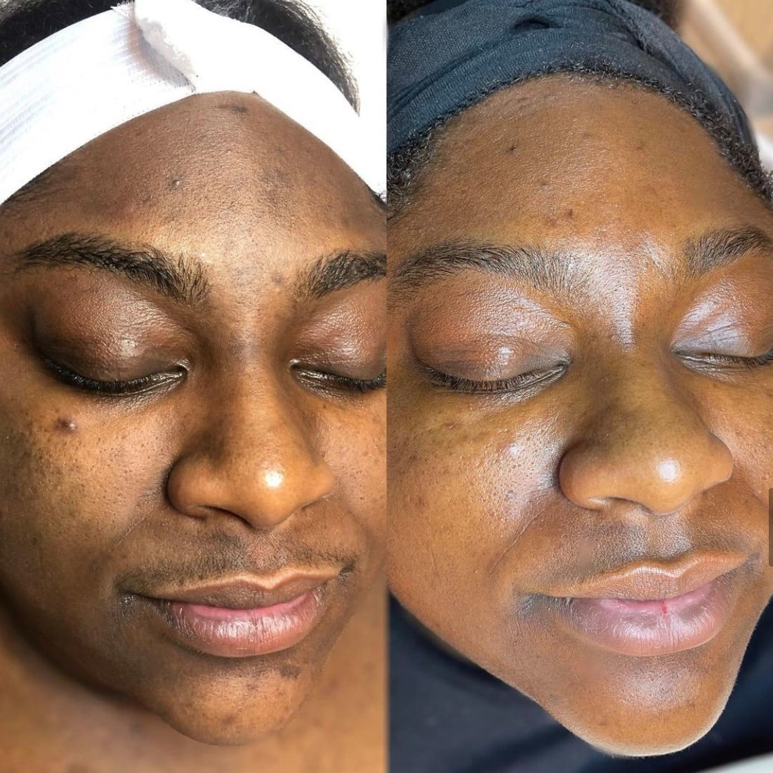 PCA Skin Review Must Read This Before Buying