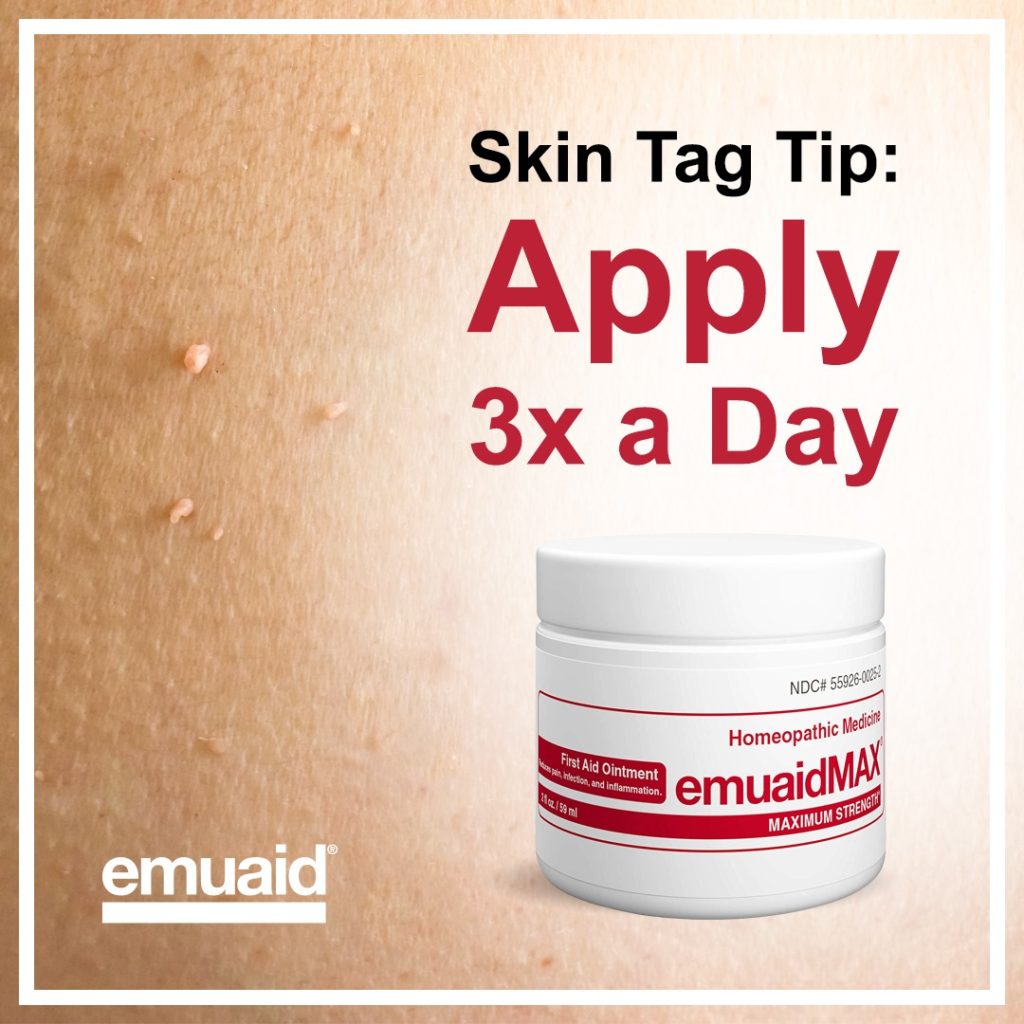 Emuaid Skin Tag Review 