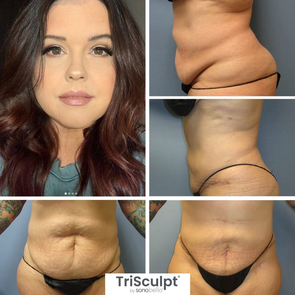 Sono Bello Cellulite Reduction Review