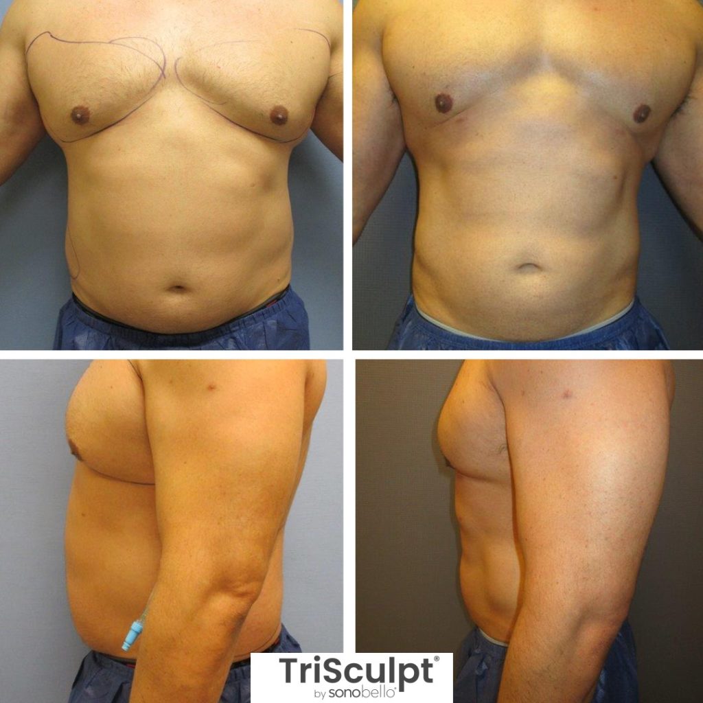 Sono Bello Male Chest Reduction Review