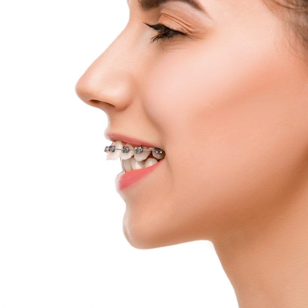 6 Best Teeth Straightener Brands