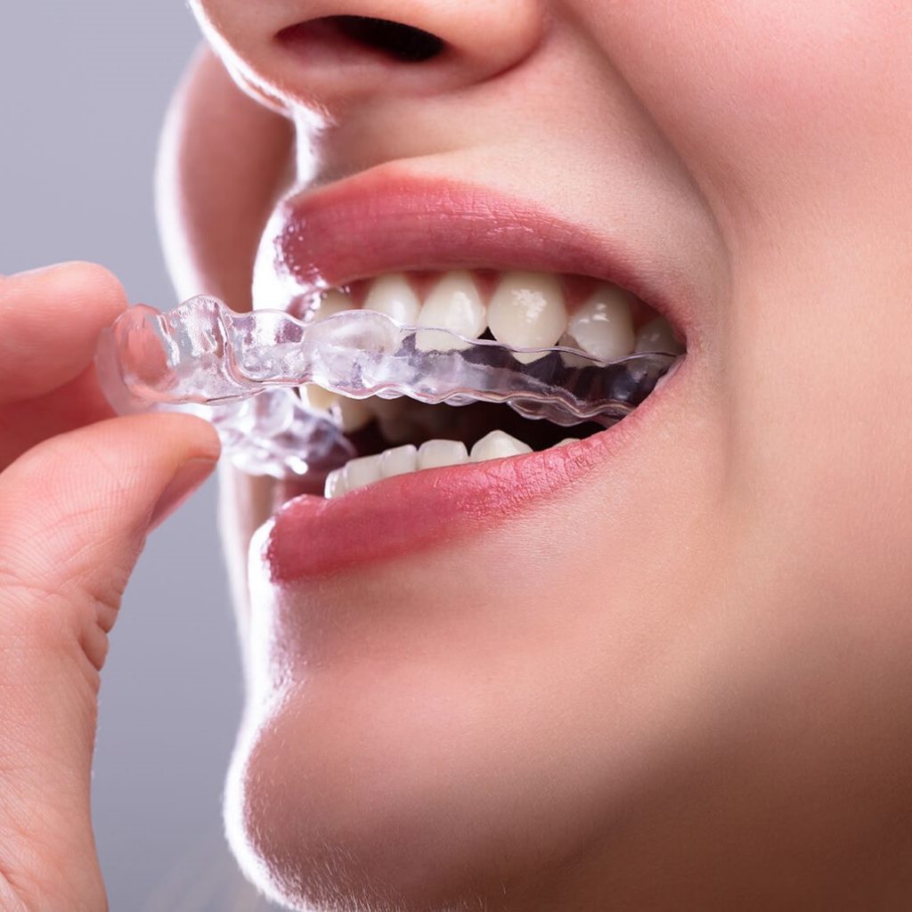 6 Best Teeth Straightener Brands