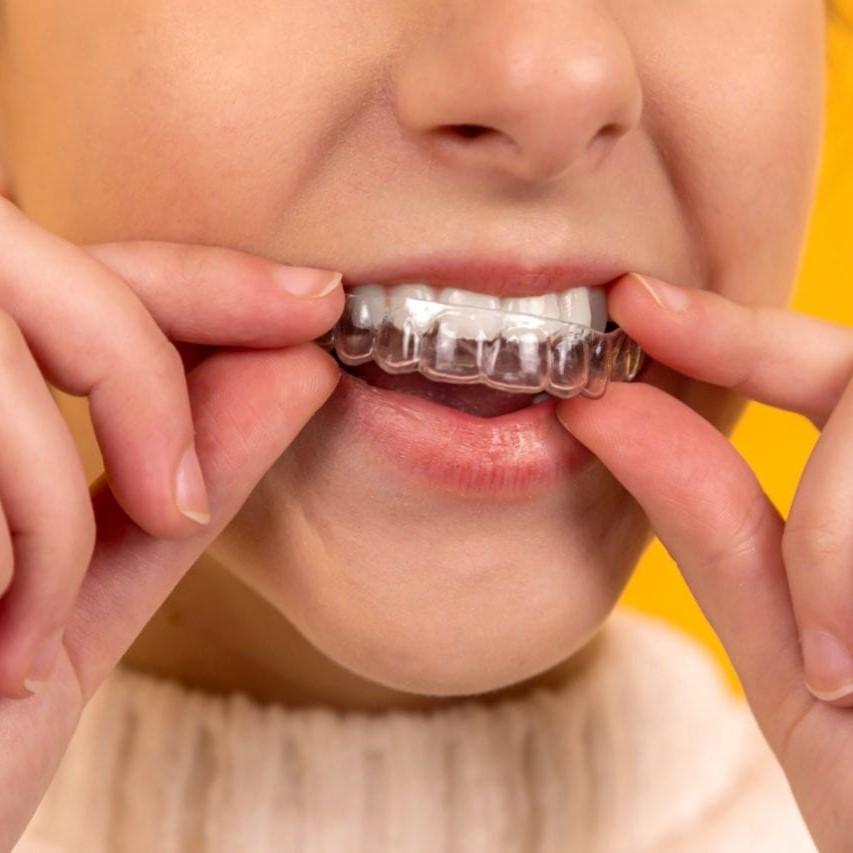 6 Best Teeth Straightener Brands