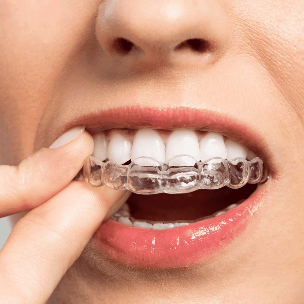 6 Best Teeth Straightener Brands