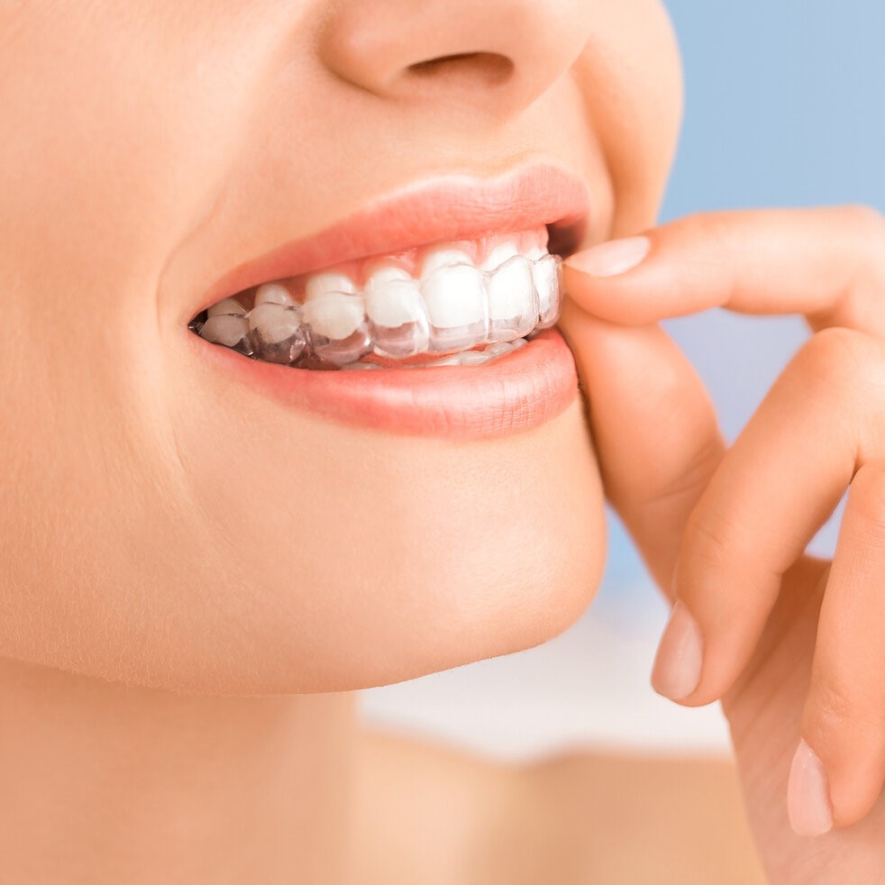 6 Best Teeth Straightener Brands 9 6 Best Teeth Straightener Brands