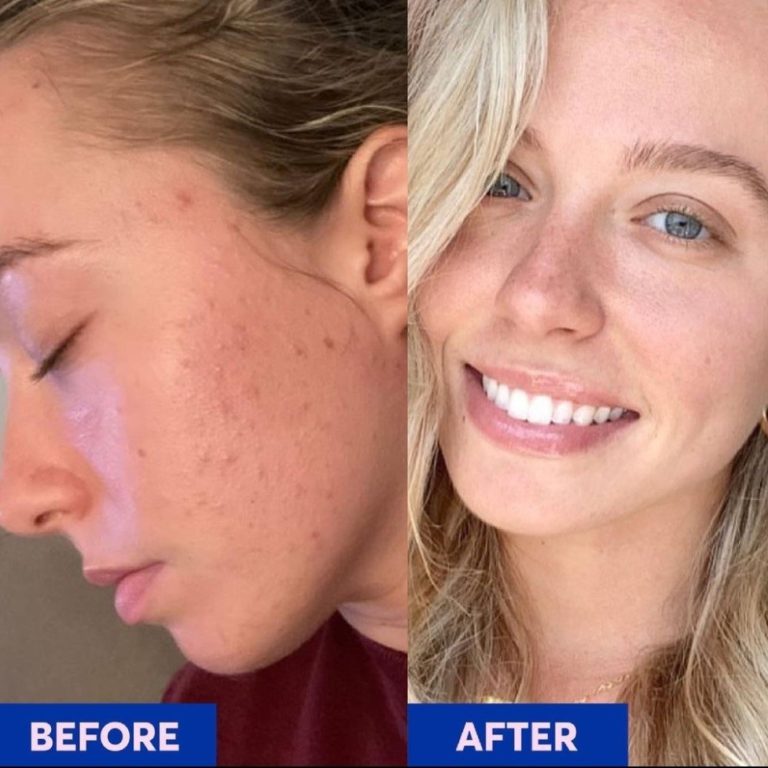 Differin Gel Review Must Read This Before Buying