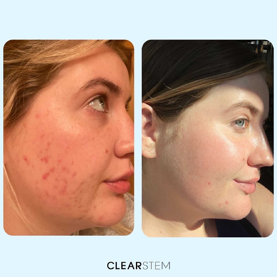 CLEARSTEM Skincare Review Must Read This Before Buying