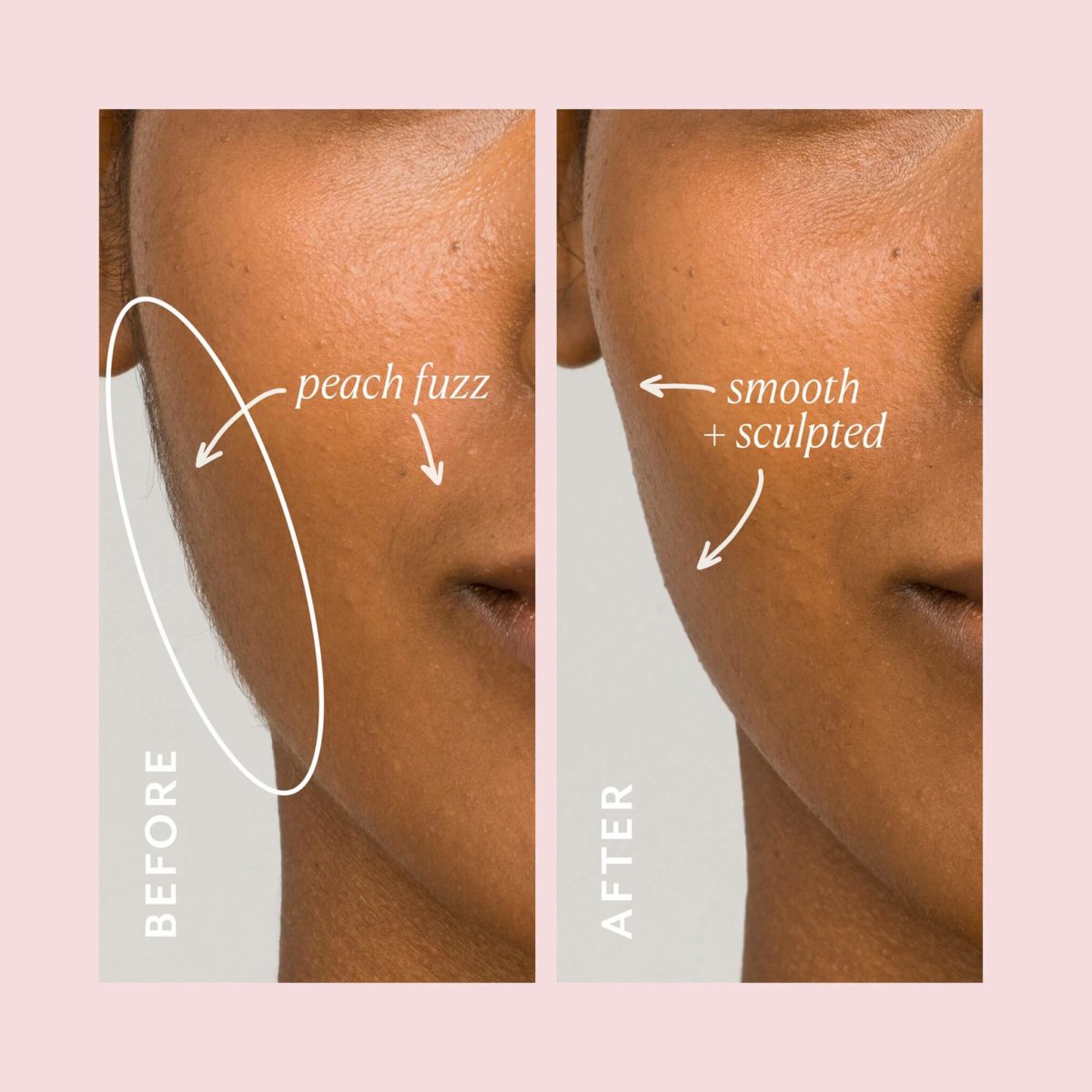 DermaFlash Review Must Read This Before Buying