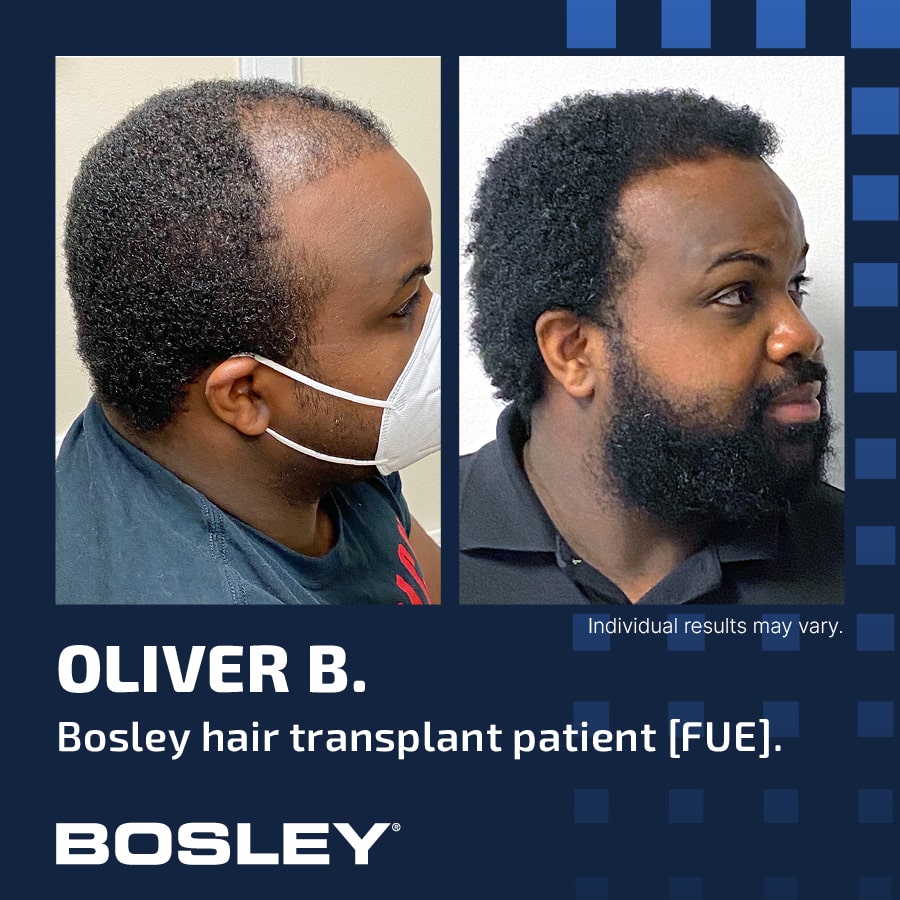 Bosley Hair Review