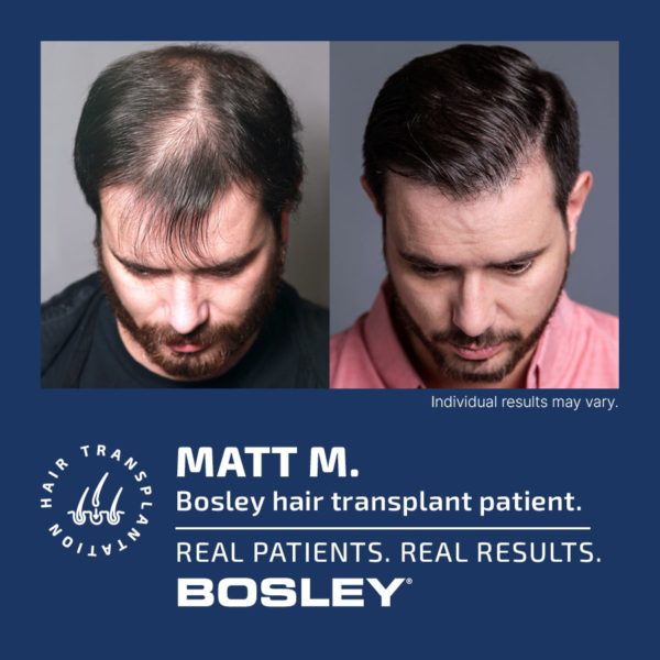 Bosley Hair Review - Must Read This Before Buying