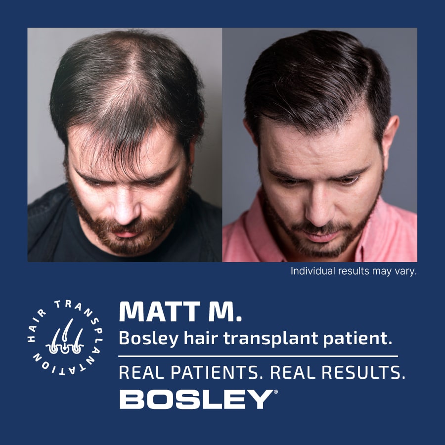 Bosley Hair Review