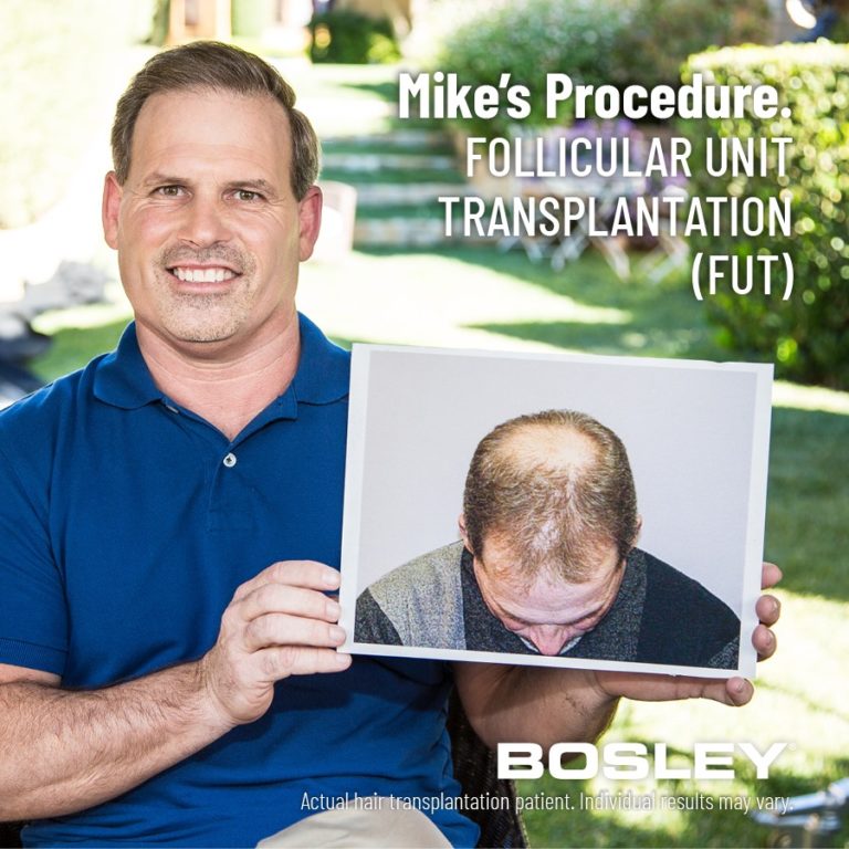 Bosley Hair Review Must Read This Before Buying