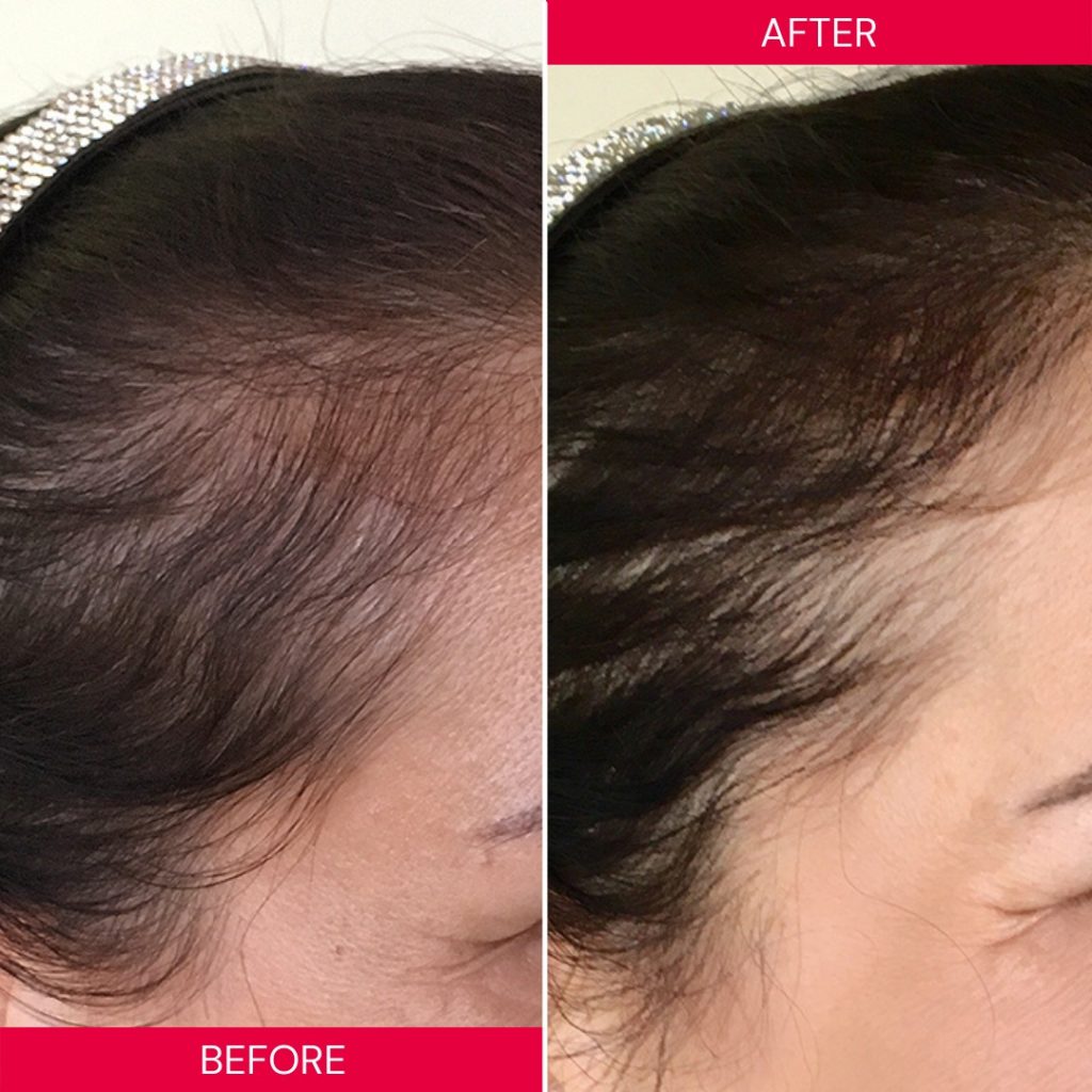 Best Laser Cap For Hair Growth