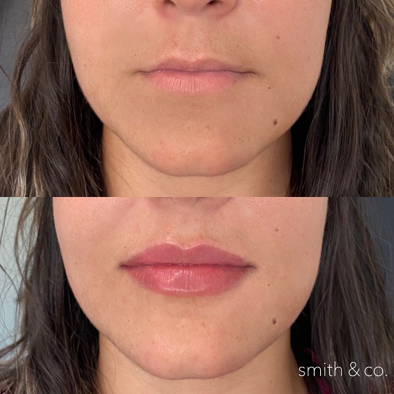 Lip Lift Before and After: Dramatic Results and Recovery Process