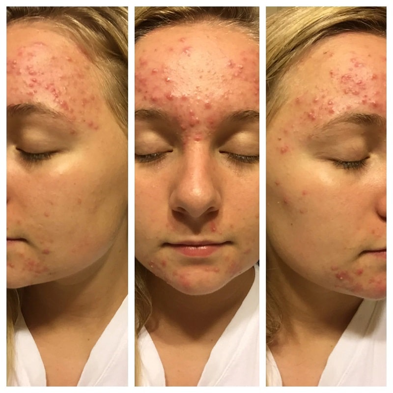 Tretinoin Before and After: A Comprehensive Analysis of its Effectiveness on Skin