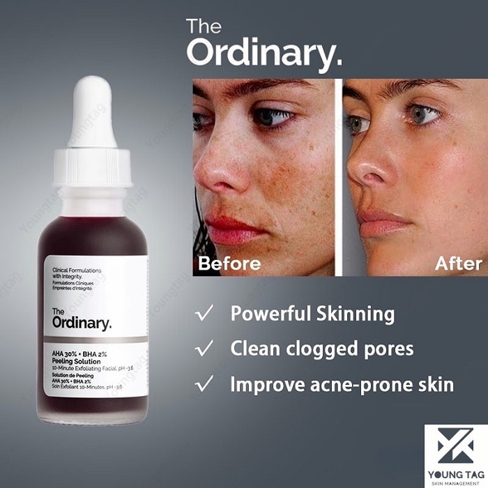 The Ordinary Peeling Solution Before and After: A Comprehensive Review