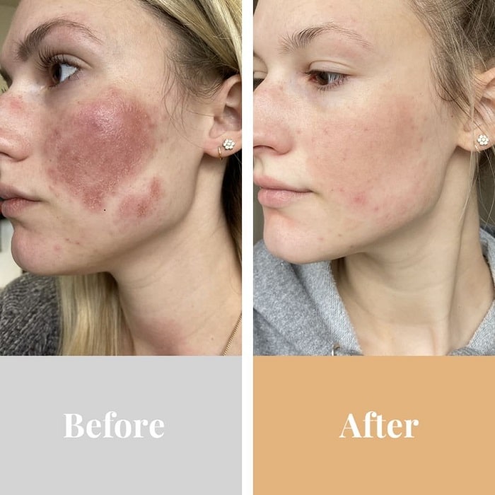 Red Light Therapy Before and After: Does It Really Work?