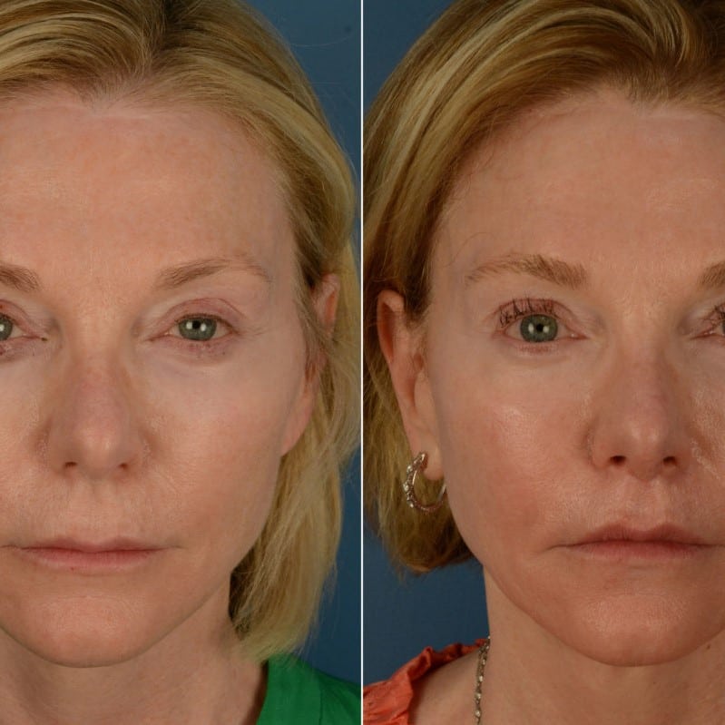 Lip Lift Before and After: Dramatic Results and Recovery Process