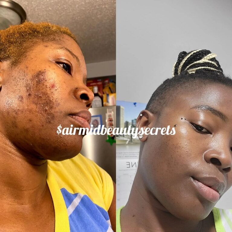 Kojic Acid Soap Before and After Does It Really Lighten Skin? Must Read This Before Buying
