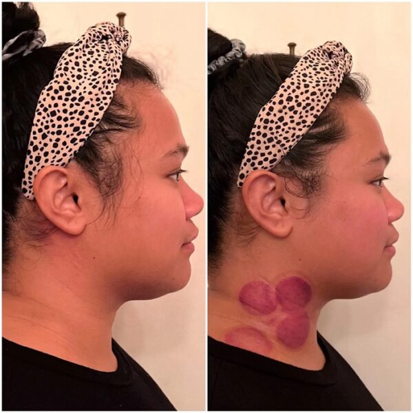 Gua Sha Before and After Benefits and Results Must Read This Before Buying