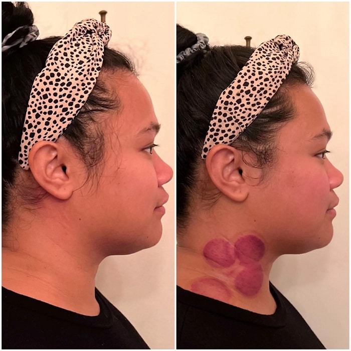Gua Sha Before and After: Benefits and Results 11 Gua Sha Before and After: Benefits and Results
