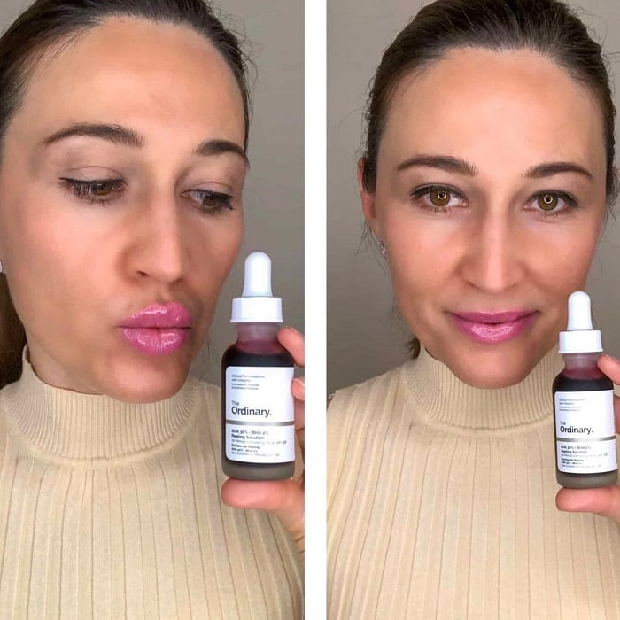 The Ordinary Peeling Solution Before and After: A Comprehensive Review