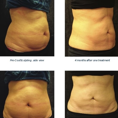Coolsculpting Before and After: Results, Side Effects, and What to Expect 11 Coolsculpting Before and After: Results, Side Effects, and What to Expect