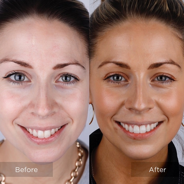 Invisalign Before and After: Transforming Your Smile with Clear Aligners