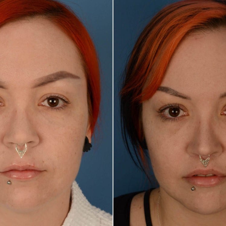 Lip Lift Before and After: Dramatic Results and Recovery Process