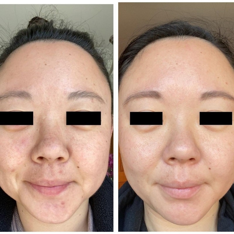 Tretinoin Before and After: A Comprehensive Analysis of its Effectiveness on Skin