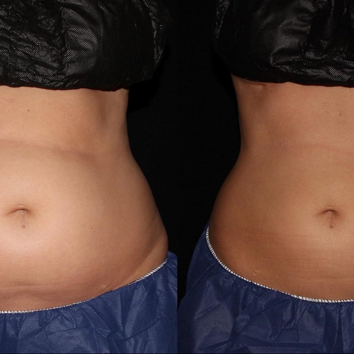 Coolsculpting Before and After: Results, Side Effects, and What to Expect 12 Coolsculpting Before and After: Results, Side Effects, and What to Expect