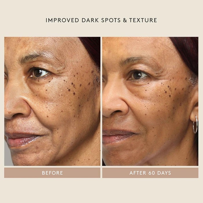 Retinol Before and After: Transform Your Skin with These Results 12 Retinol Before and After: Transform Your Skin with These Results