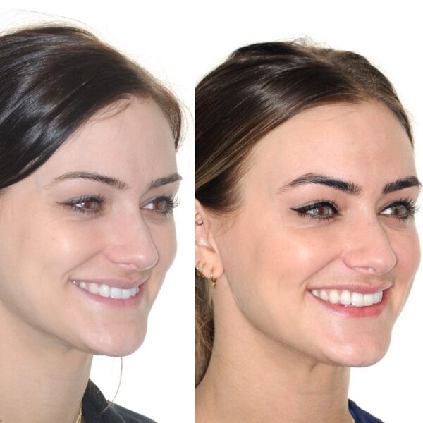 Invisalign Before and After: Transforming Your Smile with Clear ...