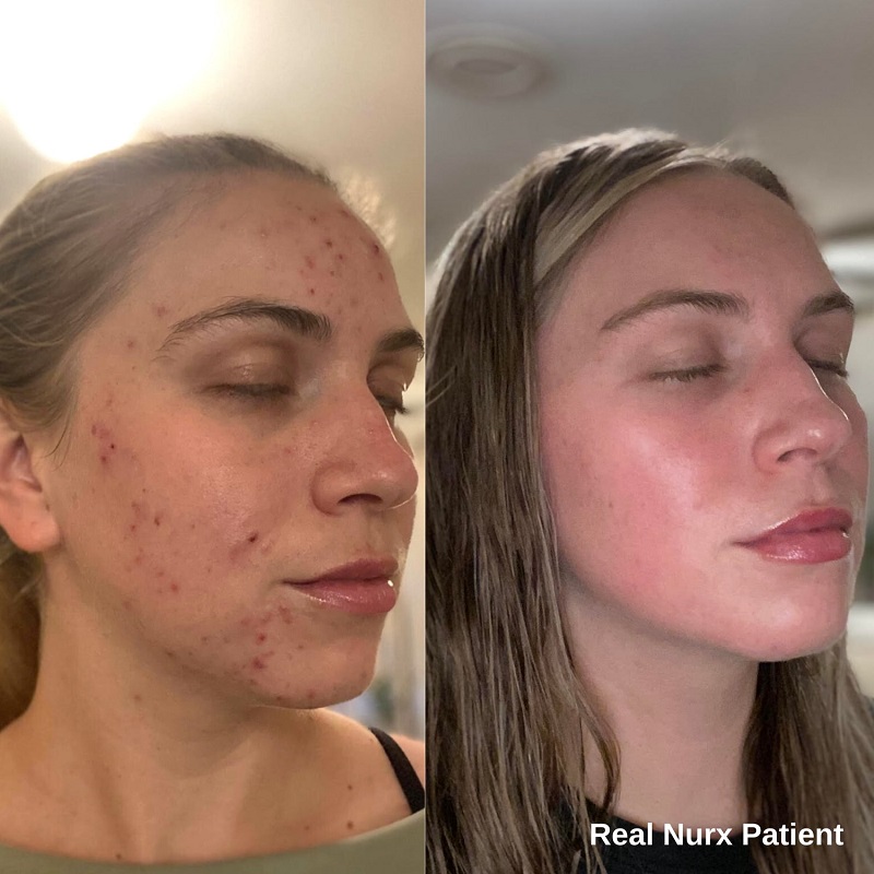 Tretinoin Before and After: A Comprehensive Analysis of its Effectiveness on Skin