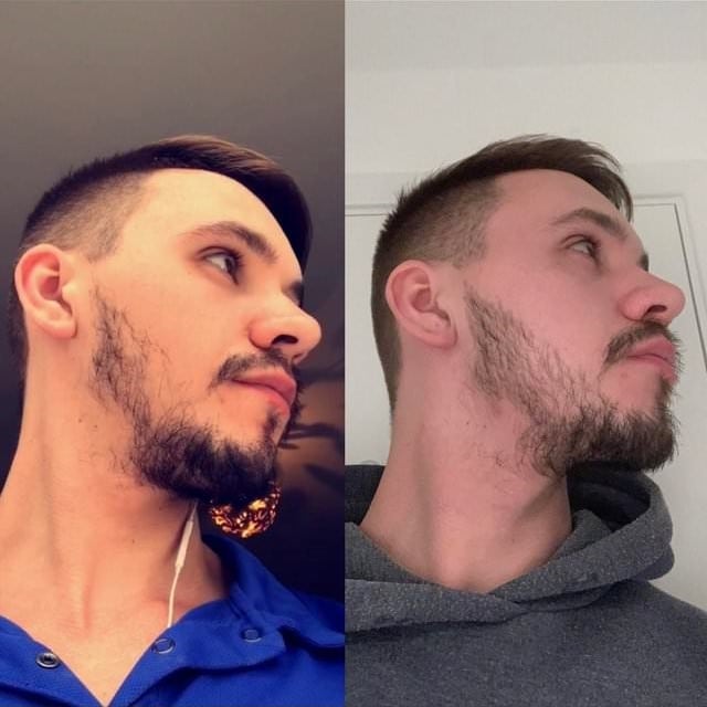 Minoxidil Before and After: Real Results and Photos