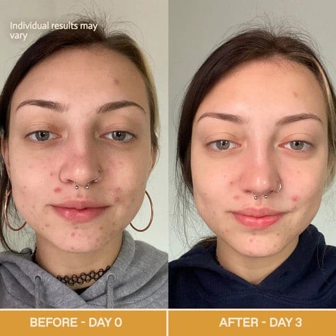 Red Light Therapy Before and After: Does It Really Work? 13 Red Light Therapy Before and After: Does It Really Work?