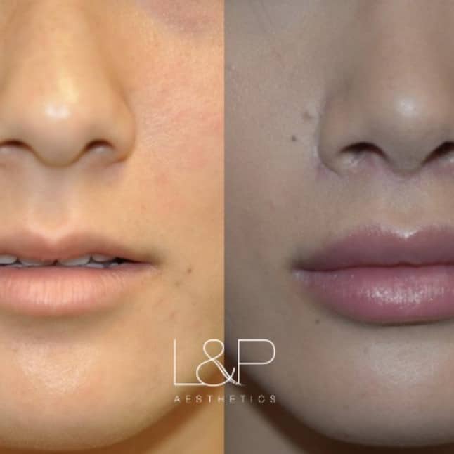 Lip Lift Before and After: Dramatic Results and Recovery Process