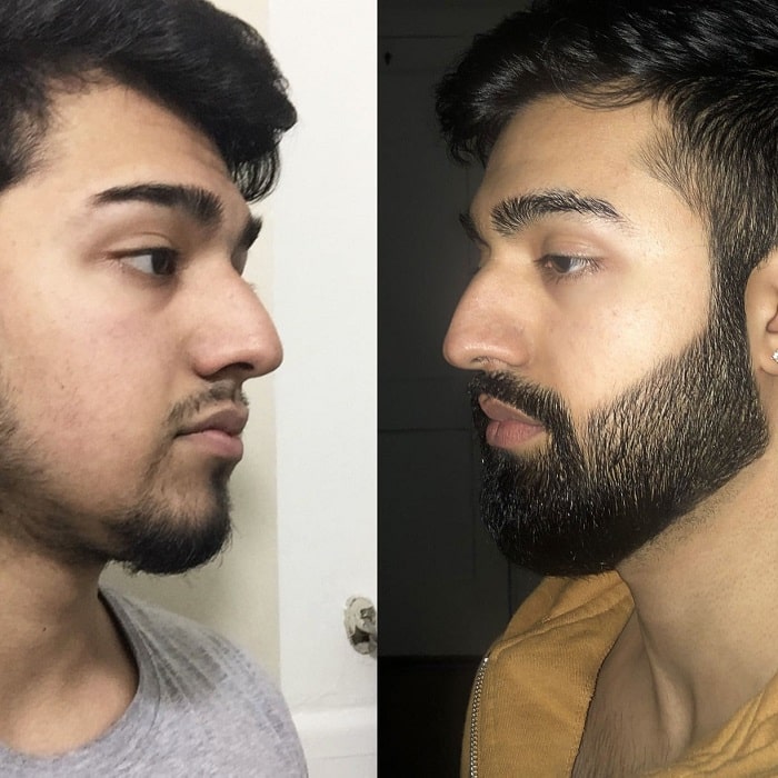 Minoxidil Before and After: Real Results and Photos