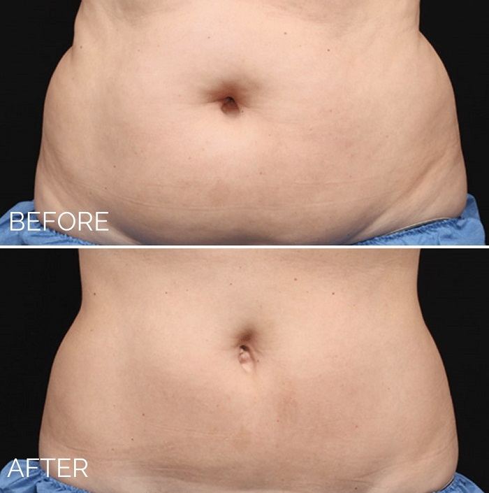 Coolsculpting Before and After: Results, Side Effects, and What to Expect 14 Coolsculpting Before and After: Results, Side Effects, and What to Expect