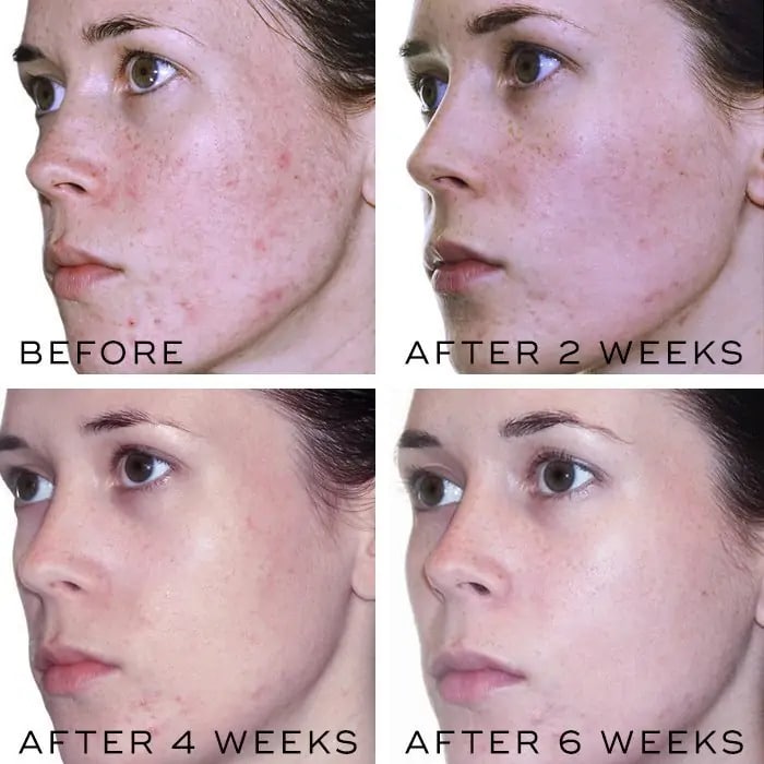 Retinol Before and After: Transform Your Skin with These Results 14 Retinol Before and After: Transform Your Skin with These Results