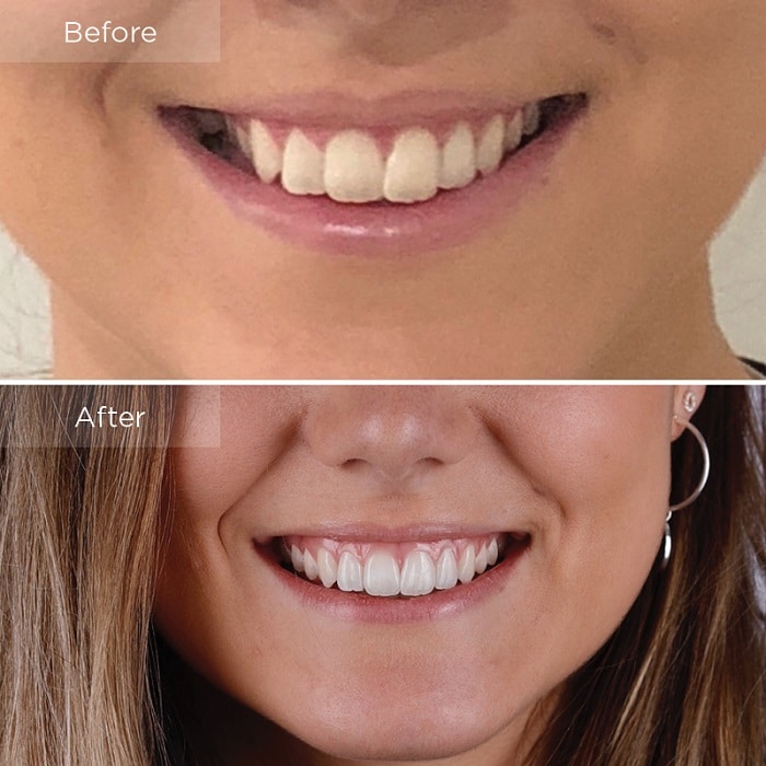 Invisalign Before and After: Transforming Your Smile with Clear Aligners