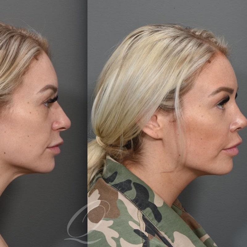 Lip Lift Before and After: Dramatic Results and Recovery Process