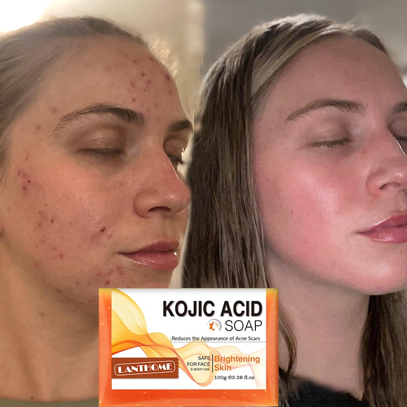 Kojic Acid Soap Before and After: Does It Really Lighten Skin?