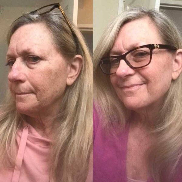 Tretinoin Before and After A Comprehensive Analysis of its Effectiveness on Skin Must Read