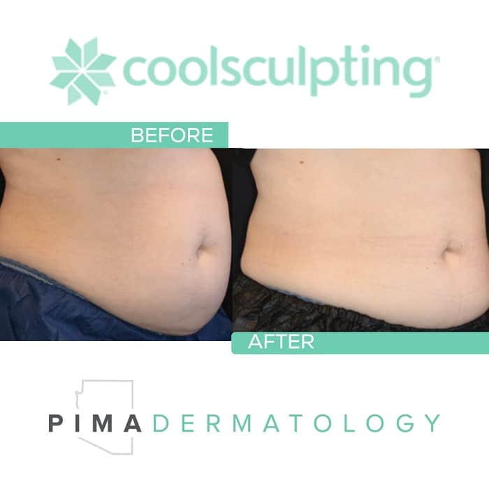 Coolsculpting Before and After: Results, Side Effects, and What to Expect 15 Coolsculpting Before and After: Results, Side Effects, and What to Expect